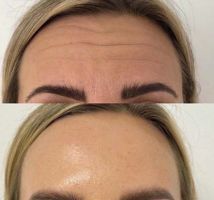 Botox före och efter