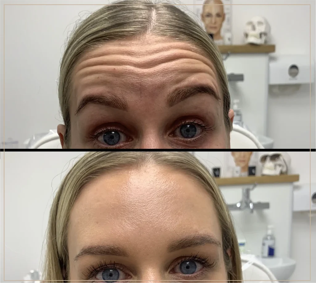 Hur länge håller botox?