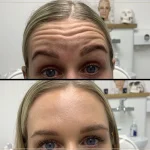 Hur länge håller botox?