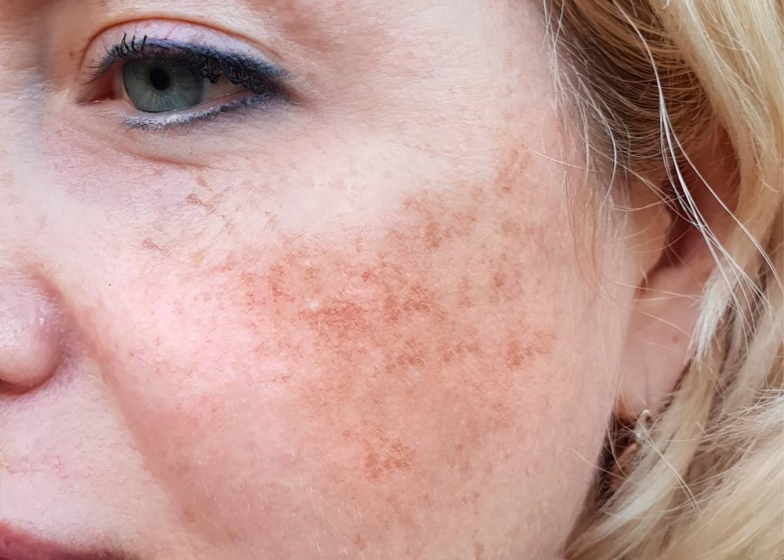 Melasma