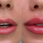 Russian lip vs traditionella läppfillers