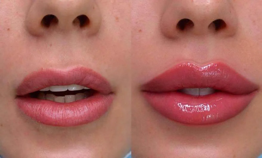 Russian lip vs traditionella läppfillers