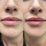 0,5 ml vs. 1,0 ml Fillers